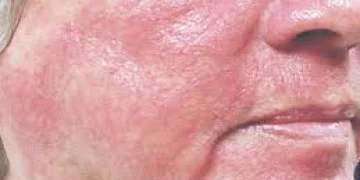 Что такое купероз на лице и как от него избавиться, эффективные средства